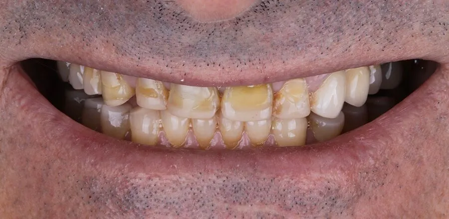 2-Before