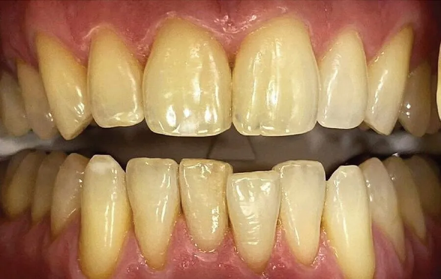 3-Whitening-Before-900x570-1