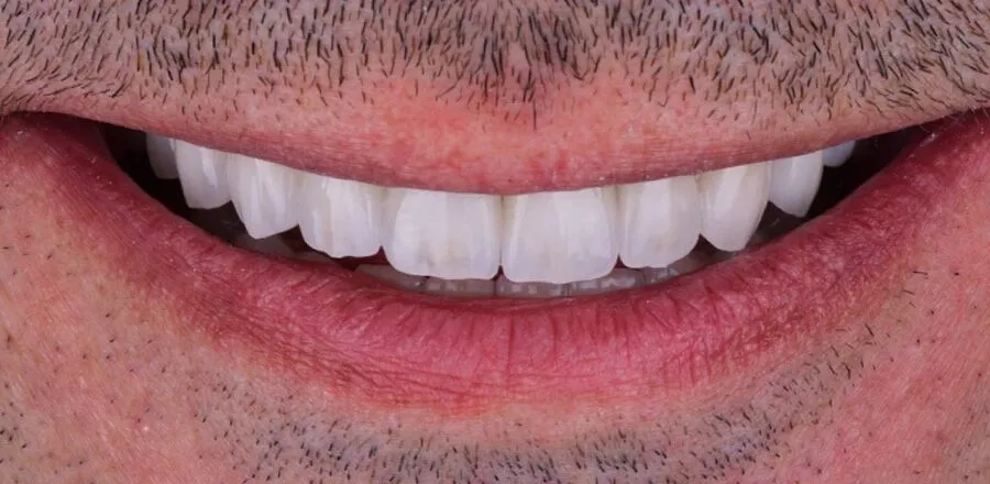 5-After